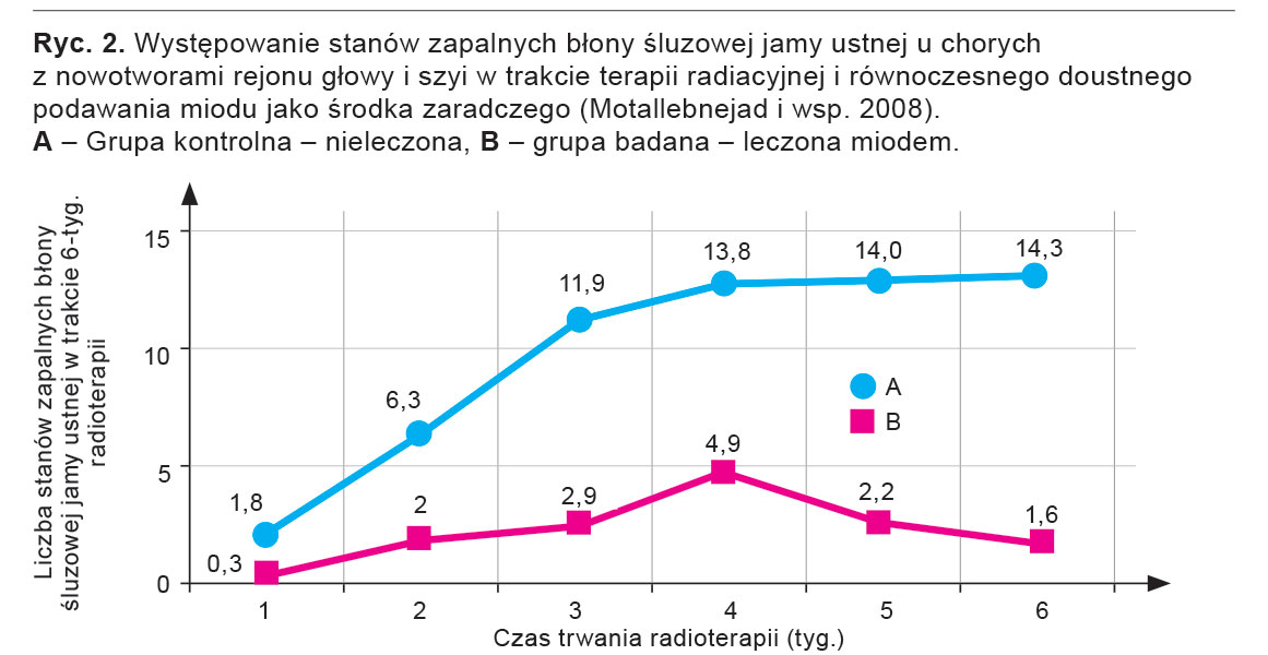 Występowanie stanów zapalnych błony śluzowej jamy ustnej u chorych z&nbsp;nowotworami głowy i szyi w trakcie terapii radiacyjnej i równoczesnego doustnego podawania miodu jako środka zaradczego (wg Biswal i wsp. 2003). 